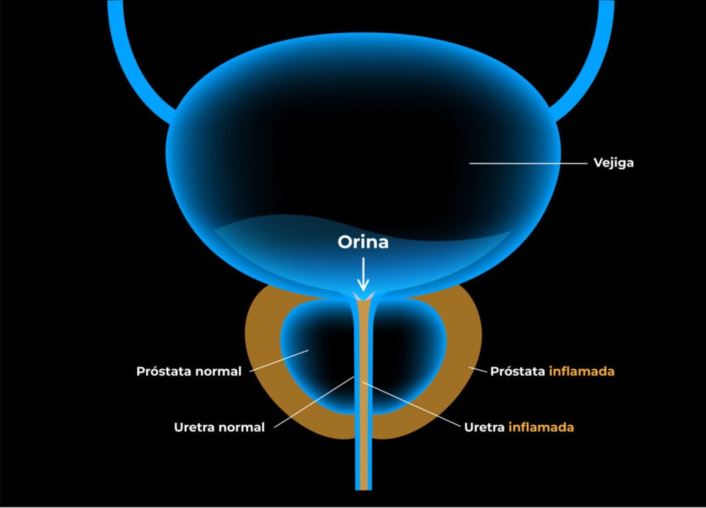 Prostatitits 1